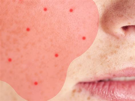 How To Tell If Your Acne Might Actually Be Rosacea Self