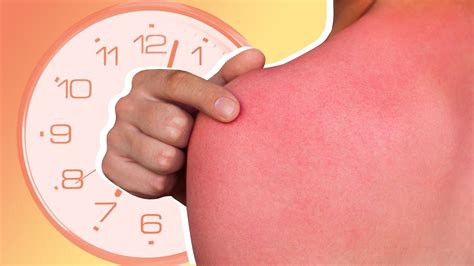 How Long Does A Sunburn Last—and Is There Any Way To Make It Heal Faster