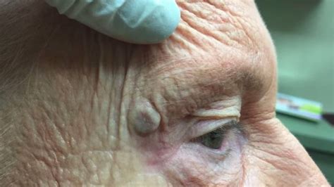 Dr Pimple Popper Tackles Massive Blackhead In Gross Yet Oddly