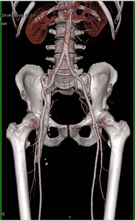 Cta With Right Iliac Venous Stent Which Narrows Vascular Case Studies