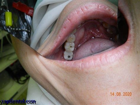 Lower Molar Implants Yap And Associates Dental Surgery Kuala Lumpur