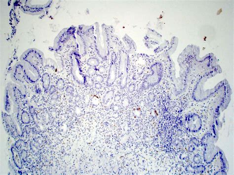 Pathology Outlines Autoimmune Gastritis