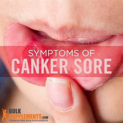 Canker Sores Symptoms Causes And Treatment
