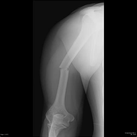 Humeral Shaft Fractures Trauma Orthobullets