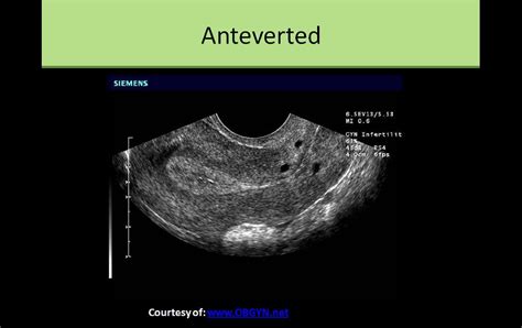 Anteverted Uterus On Ultrasound Diagnostic Medical Sonography