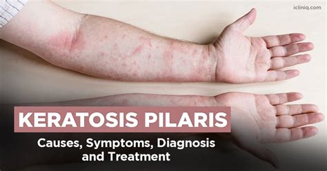Understanding Keratosis Pilaris Bumps Causes And Management