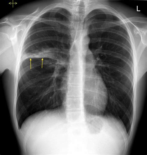 Right Lung Atelectasis