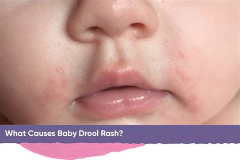 Baby Drool Rash Causes And Treatments Everything You Need To Know