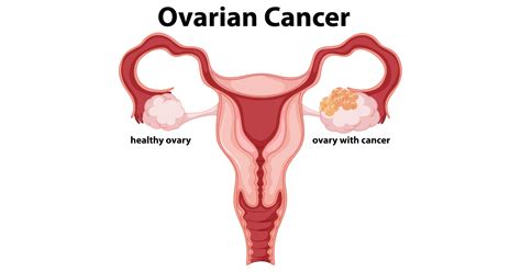 Ovarian Cancer Symptoms Causes Prevention And Treatments