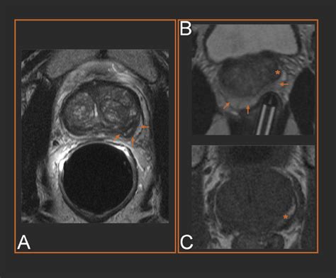 Mri Guided Biopsy Of The Prostate Increases Diagnostic Performance In