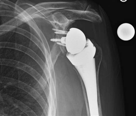 Reverse Total Shoulder Arthroplasty With Humeral Head Autograft Fixed