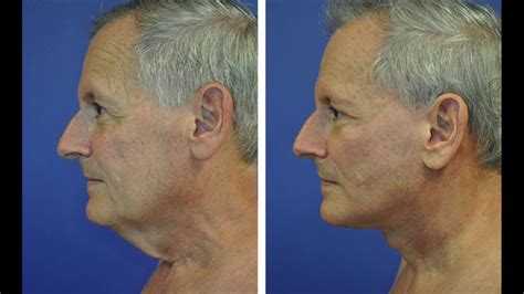 Mens Neck Lift The Only Hd Mens Neck Lift Hd Neck Lift By Dr