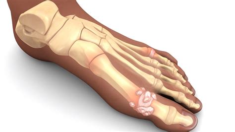 Best Sprained Big Toe Treatment Turf Toe Home Treatment