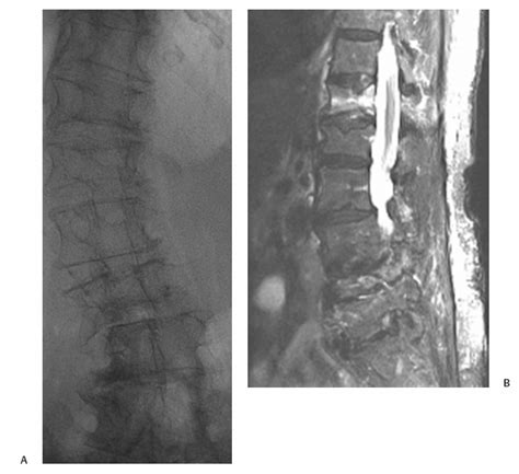 Vertebral Compression Fractures Kyphoplasty Radiology Key