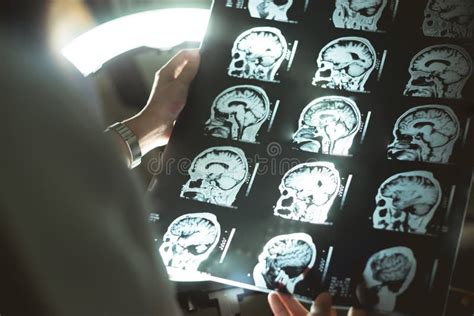 Brain MRI and dementia stock image. Image of diagnostic - 105373497