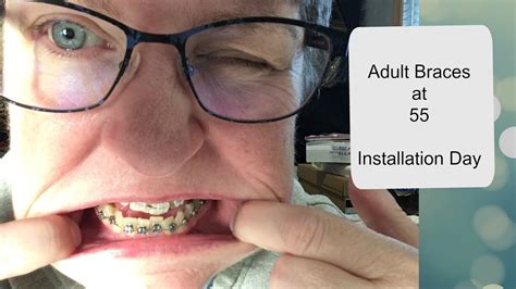 Adult Braces At Installation Youtube