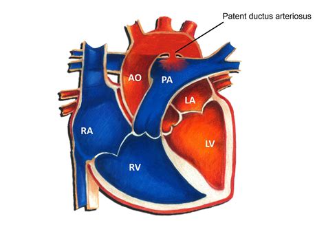 Become a pda member today! Patent Ductus Arteriosus - Pediatric Heart Specialists