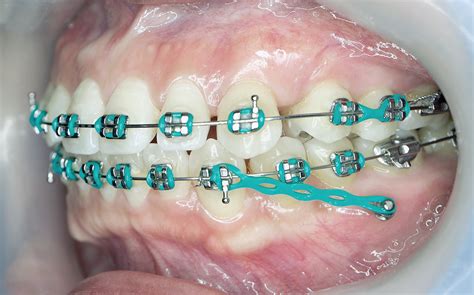 Tads Mini Implants And Mini Screws Orthodontics By Jackie