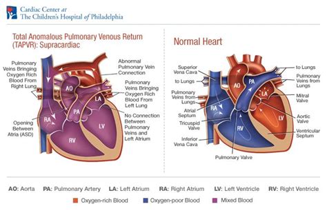 In a child born with total anomalous — which means abnormal — pulmonary venous return (tapvr), the pulmonary veins connect to other veins and ultimately drain their blood into the right atrium. TAPVR Total Anomalous Pulmonary Venous Return Supracardiac ...