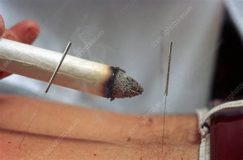 Acupuncture And Moxibustion Stock Image C0123977 Science Photo