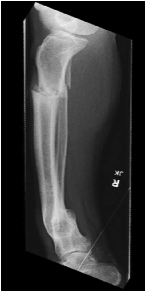 Distal Tibial Metaphyseal Malunion Treated With Clamshell Os Jbjs