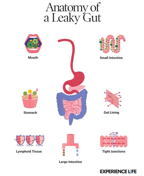 Anatomy Of A Leaky Gut Infographic