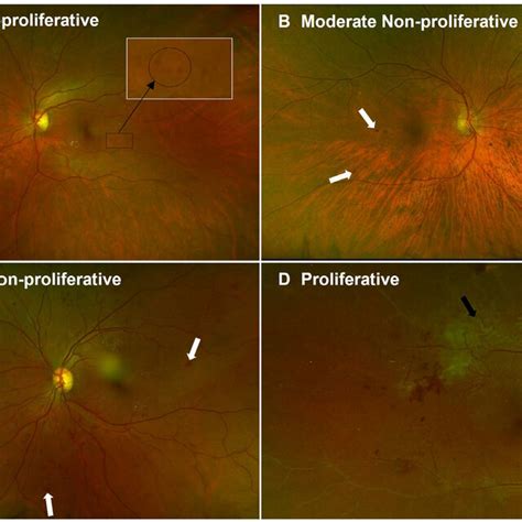 Stages Of Diabetic Retinopathy A Mild Non Proliferative Diabetic
