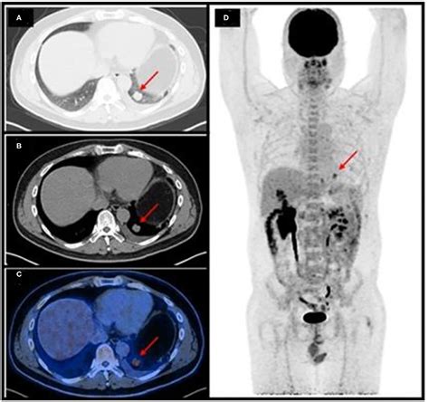 Frontiers Case Report 18f Fdg Petct Demonstrating Malignant Spread