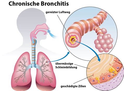 Bronchitis Symptome Ansteckung Dauer Und Behandlung
