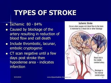 Image Result For Cerebrovascular Accident Cerebrovascular Accident