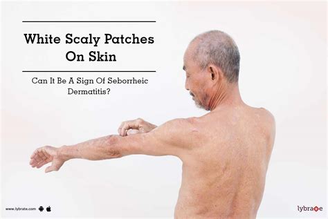 White Scaly Patches On Skin Can It Be A Sign Of Seborrheic Dermatitis