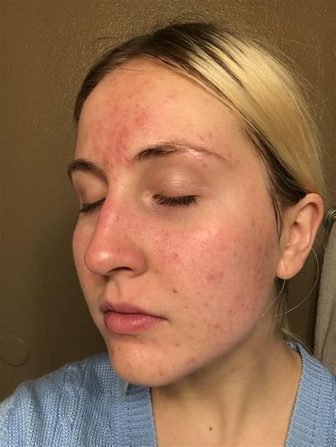 Does This Look More Like Fungal Acne Or Typical Ive Been Dealing With