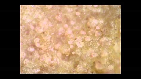 Scabies Mites On Skin Crust Youtube