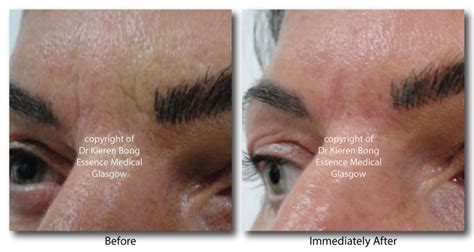 Dermal Fillers For Frown Lines Botox Injections For Frown Line Glasgow