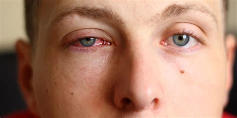Orbikularis myokymia merupakan kedutan yang muncul akibat kontraksi otot di kelopak mata bagian atas atau bawah. Waspadai Penyakit Mata Merah yang Sangat Menular - Kompas.com