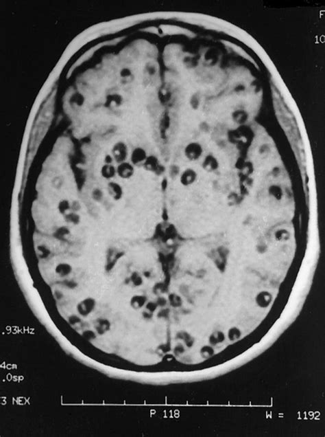 This Mri Image Shows The Brain Of A Patient Suffering From