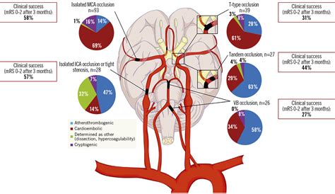 Long Term Outcomes Of Thrombectomy For Acute Ischaemic Stroke By