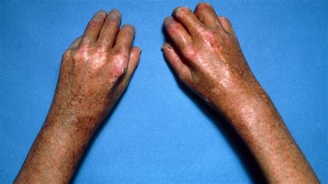 Diabetic Skin Rash On Arms And Wrists Diabeteswalls