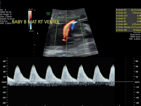 Umbilical Artery Doppler Sonographic Tendencies