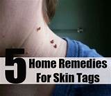 Insurance Cover Skin Tag Removal Pictures