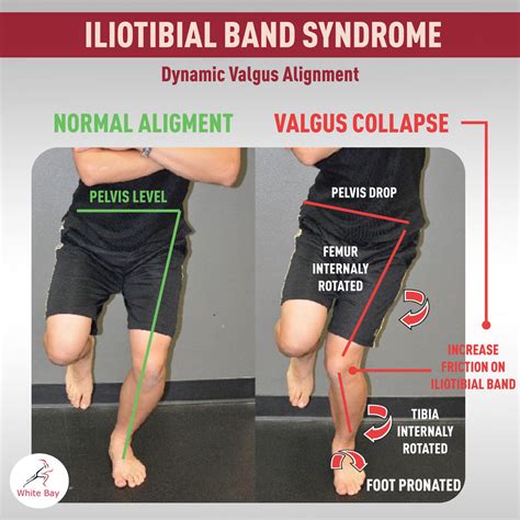 Iliotibial Band Syndrome Treatment