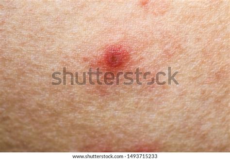 Skinbumpslumpsblisters Caused By Insect Sandfly Bites 스톡 사진 1493715233