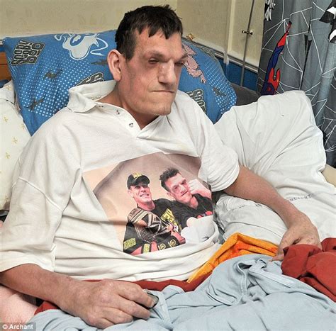 7ft Man With Proteus Syndrome Which Meant He Never Stopped Growing Dies