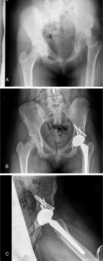 Ceramic On Ceramic Total Hip Arthroplasty In Patients Younger Than 20