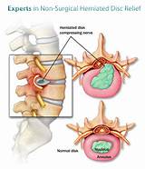 Chiropractic Treatment For Herniated Disc Pictures