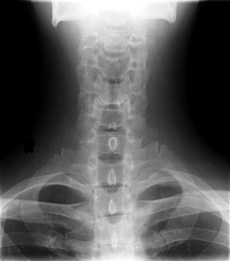 Plikcervical Xray Lower Ap View Wikipedia Wolna Encyklopedia