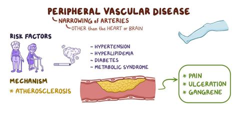 Peripheral Vascular Disease Clinical Practice Osmosis