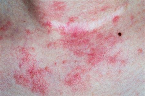 Rash On Chest Images Galleries With A Bite