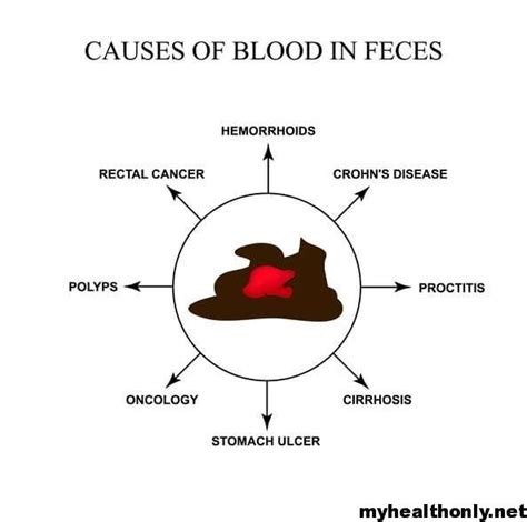 Blood In Stool Symptoms Causes Risks And Treatment My Health Only