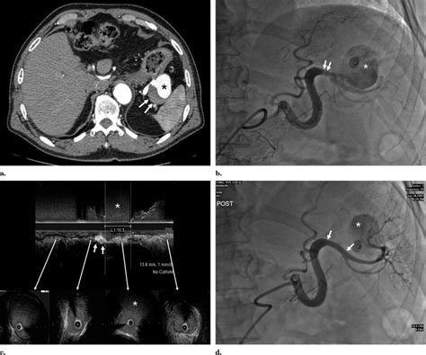 Endovascular Treatment Of A Distal Splenic Artery Aneurysm With Use Of